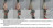 Бедренная часть ортеза medi HIP ORTHOSIS